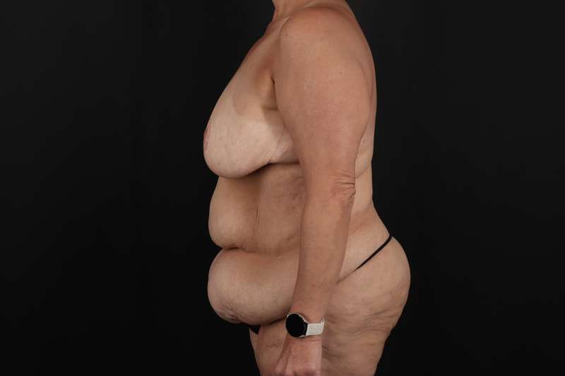 Fleur De Lis Circumferential Body Lift Before & After Patient #4275