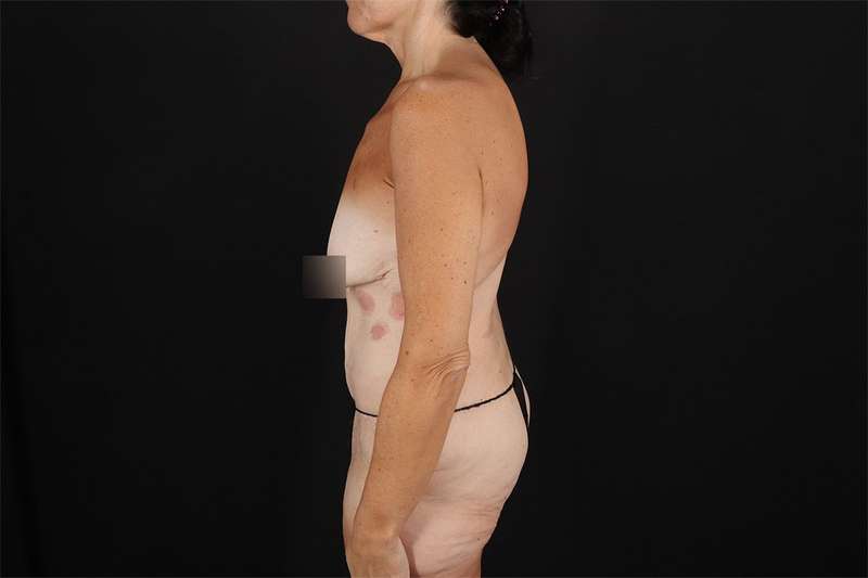 Fleur De Lis Circumferential Body Lift Before & After Patient #4288