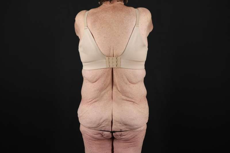 Fleur De Lis Tummy Tuck Before & After Patient #4327