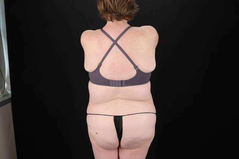 Fleur De Lis Tummy Tuck Before & After Patient #4340