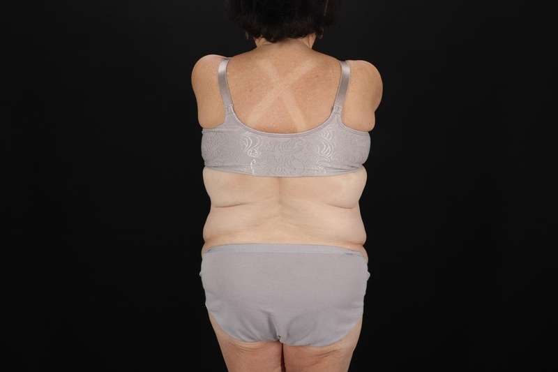Fleur De Lis Tummy Tuck Before & After Patient #4353