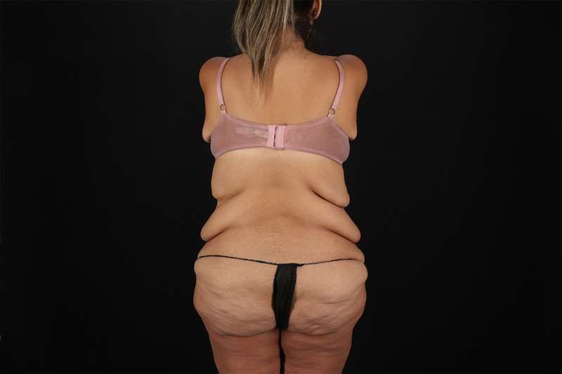 Fleur De Lis Tummy Tuck Before & After Patient #4366
