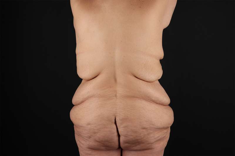 Fleur De Lis Tummy Tuck Before & After Patient #4379