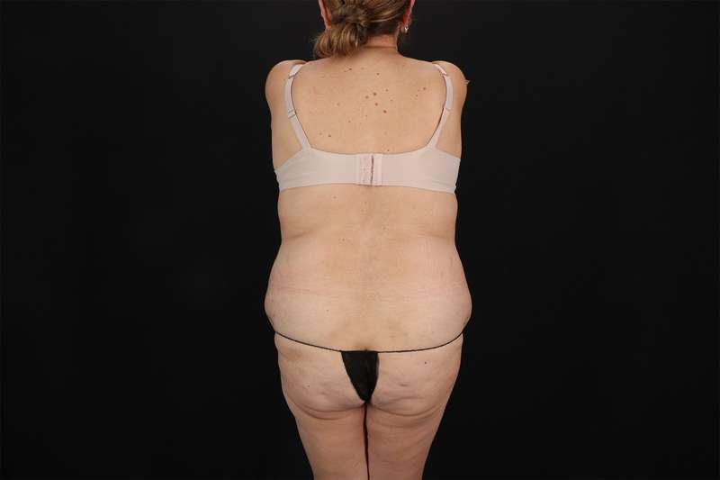 Fleur De Lis Tummy Tuck Before & After Patient #4392
