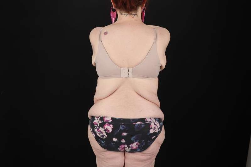 Fleur De Lis Circumferential Body Lift Before & After Patient #4236