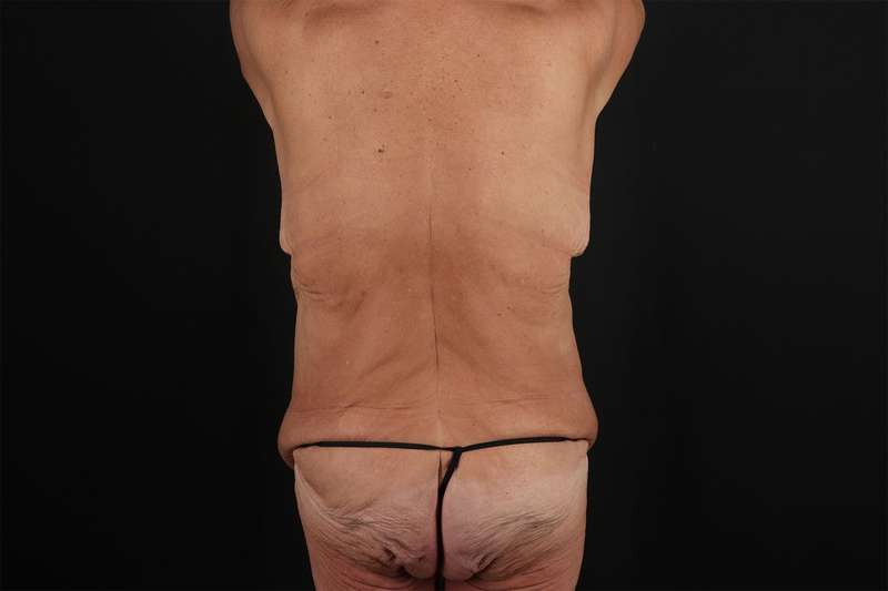 Fleur De Lis Circumferential Body Lift Before & After Patient #4262