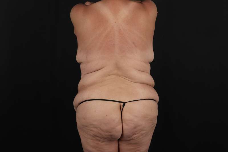 Fleur De Lis Circumferential Body Lift Before & After Patient #4275