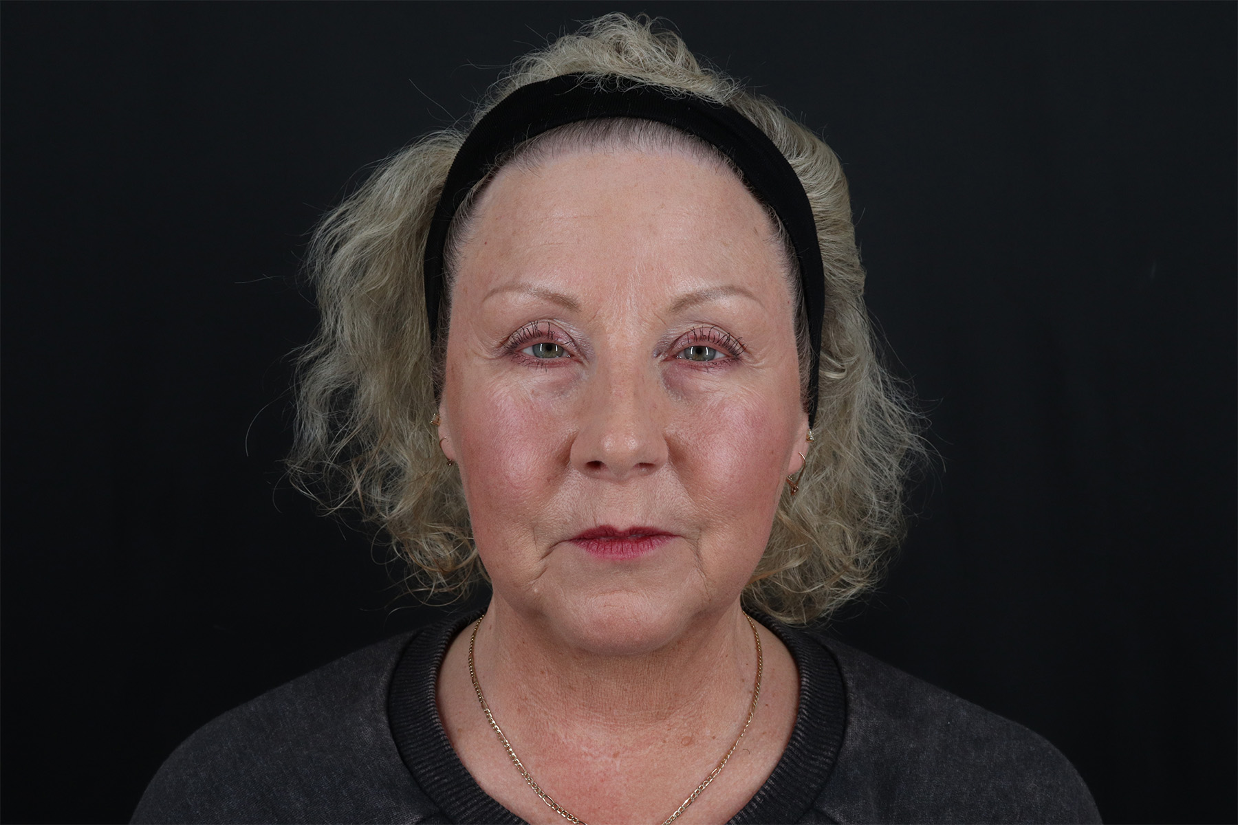 Face & Neck Lift Before & After Patient #4693