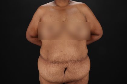 Circumferential Body Lift Before & After Patient #4494
