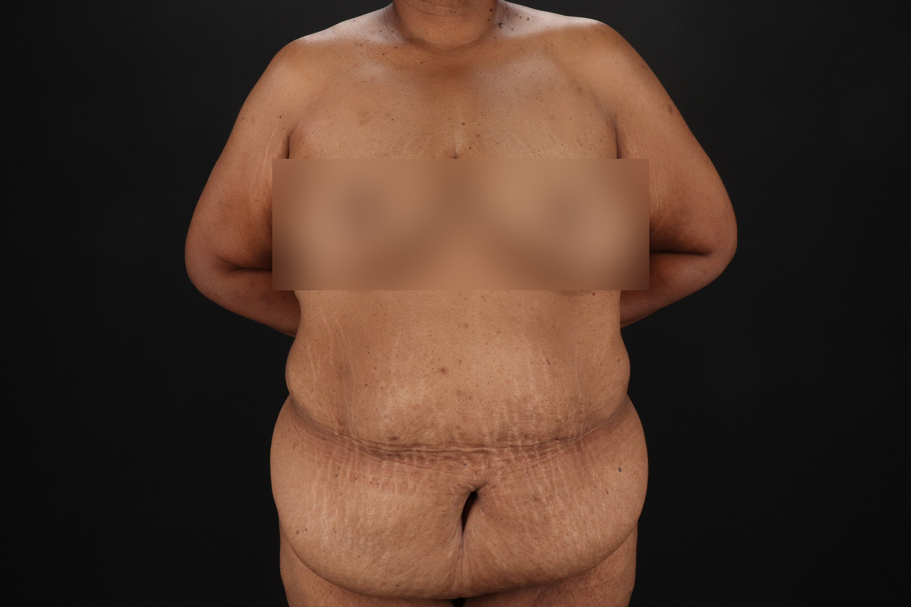 Circumferential Body Lift Before & After Patient #4494
