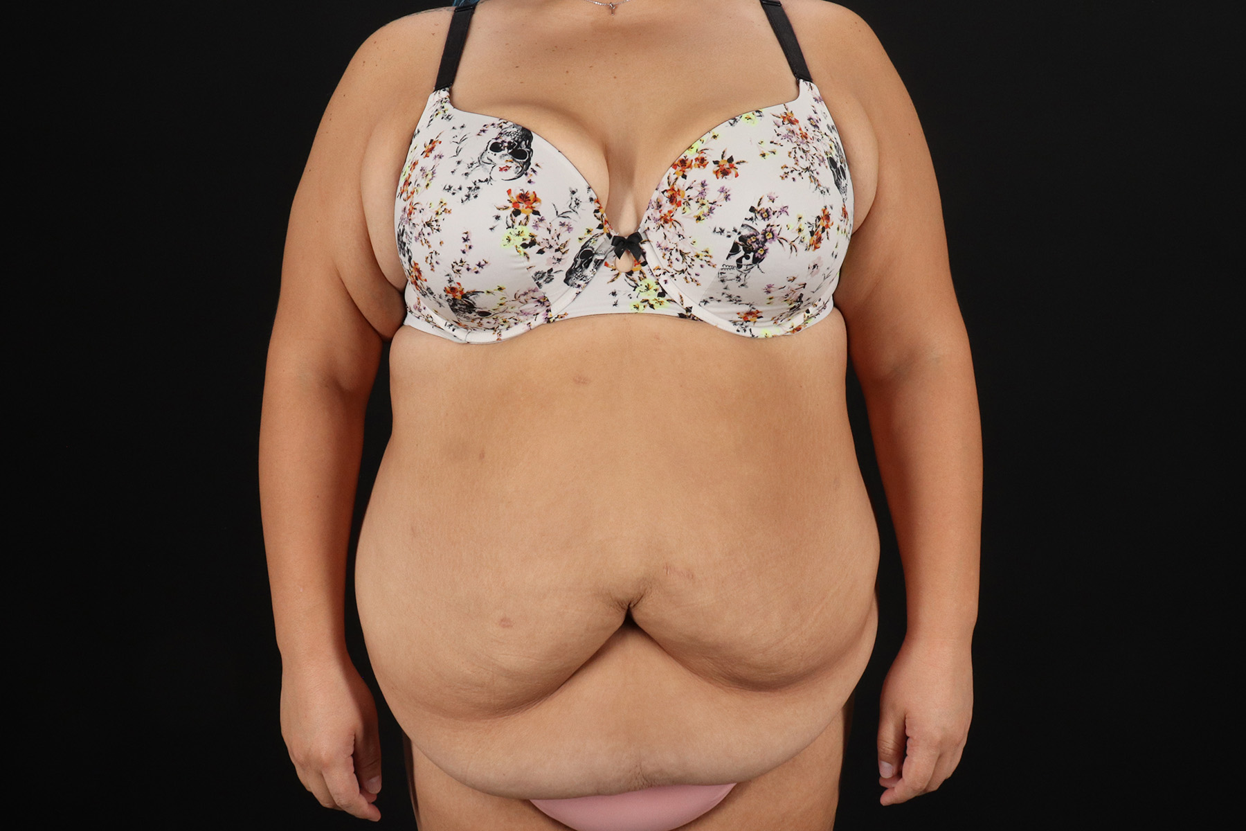 Circumferential Body Lift Before & After Patient #4499