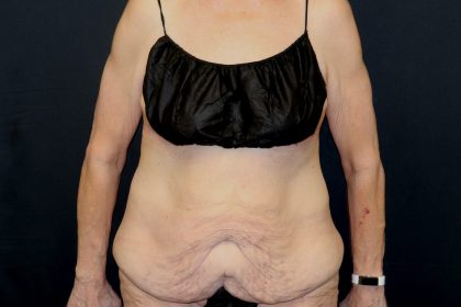 Circumferential Body Lift Before & After Patient #4495
