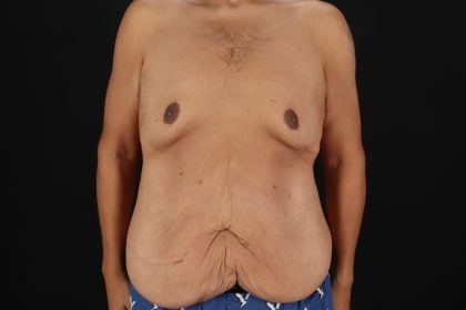Circumferential Body Lift Before & After Patient #4497