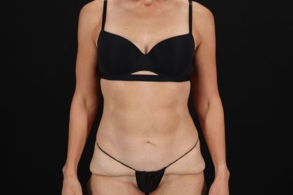 Circumferential Body Lift Before & After Patient #4493