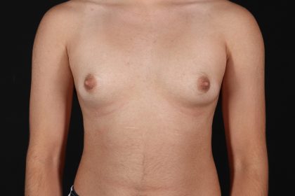 FTM Chest Contouring Before & After Patient #4694