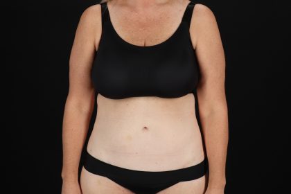 Circumferential Body Lift Before & After Patient #4500