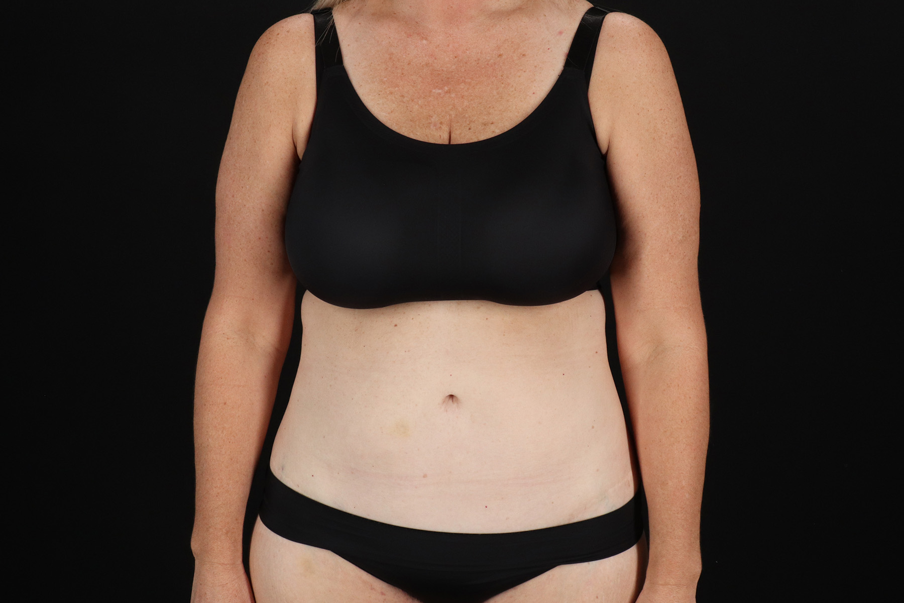 Circumferential Body Lift Before & After Patient #4500