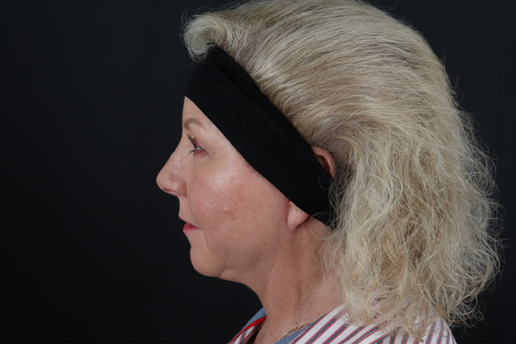 Face & Neck Lift Before & After Patient #4693