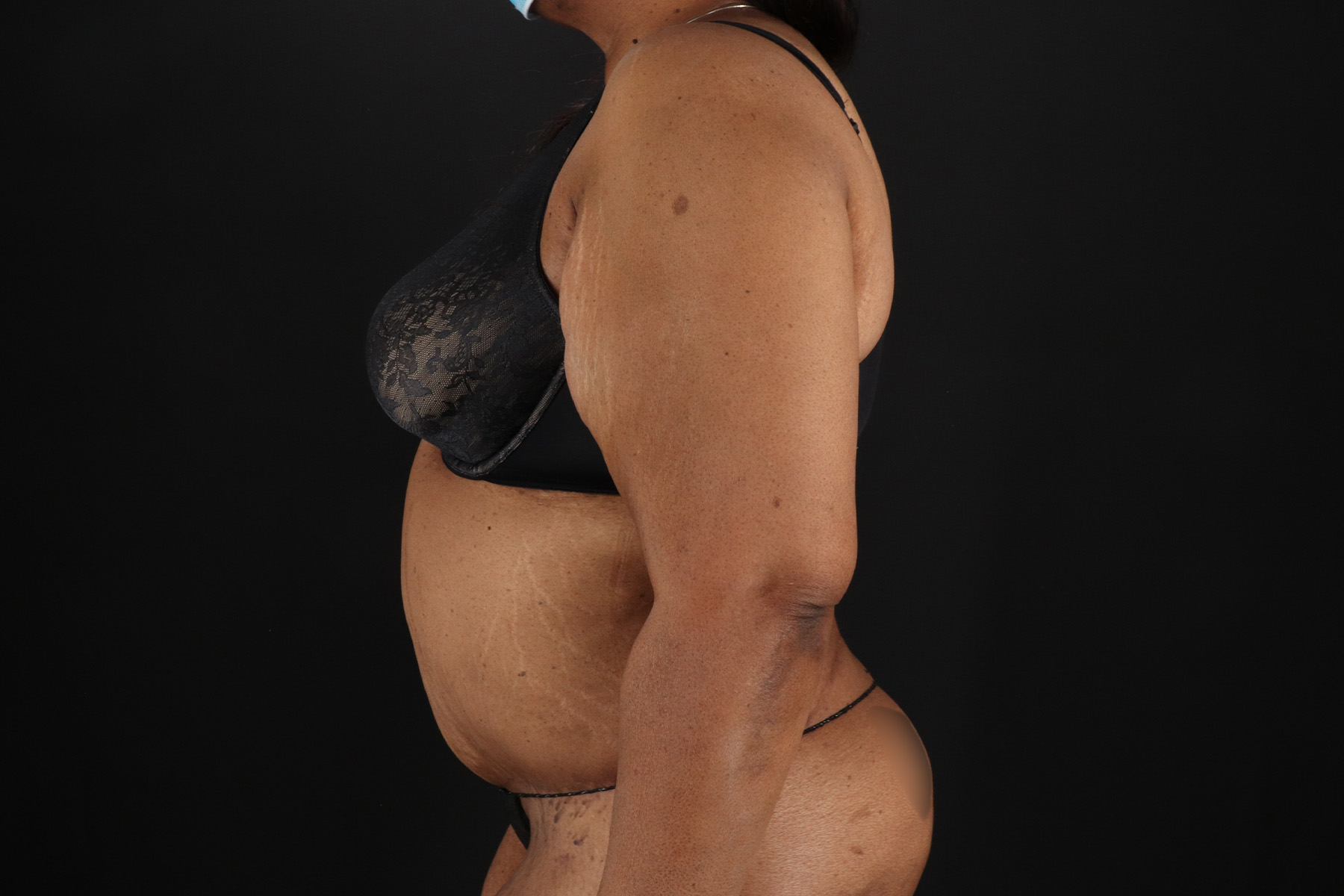 Circumferential Body Lift Before & After Patient #4494