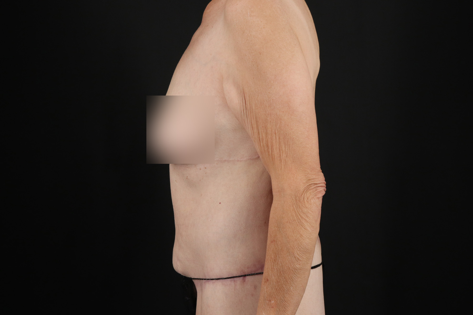 Circumferential Body Lift Before & After Patient #4495