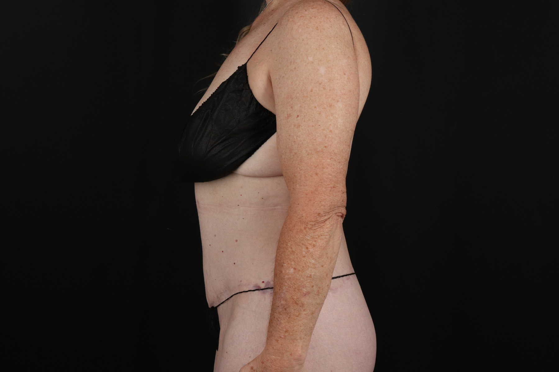 Circumferential Body Lift Before & After Patient #4490