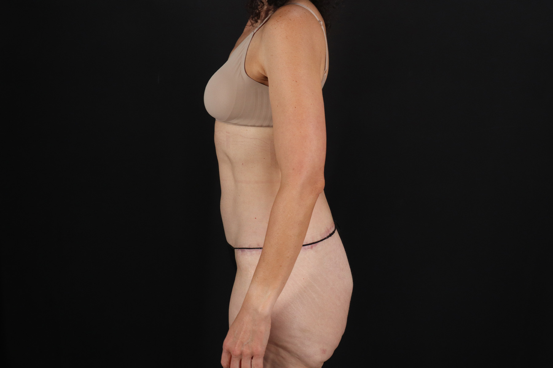 Circumferential Body Lift Before & After Patient #4493
