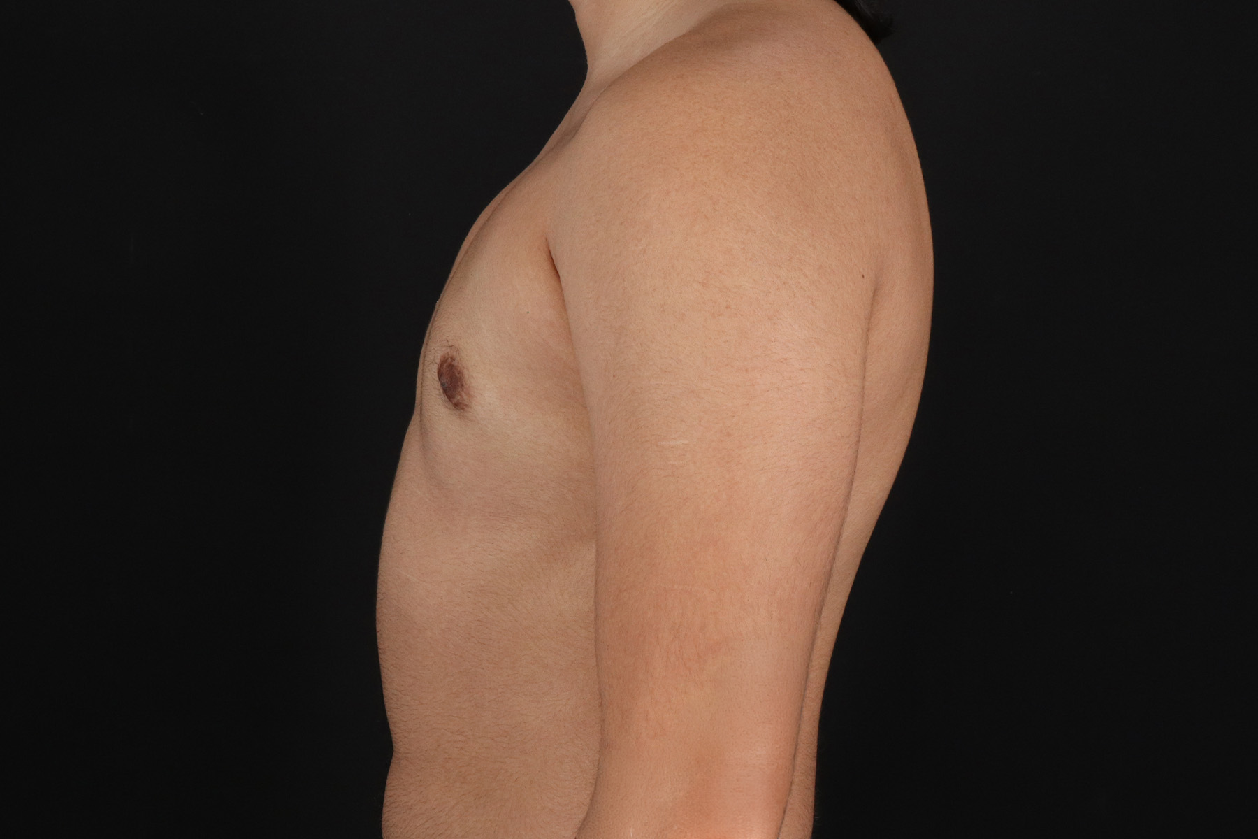 FTM Chest Contouring Before & After Patient #4694