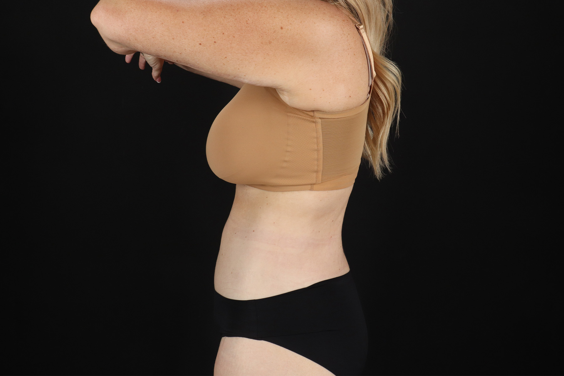 Circumferential Body Lift Before & After Patient #4500