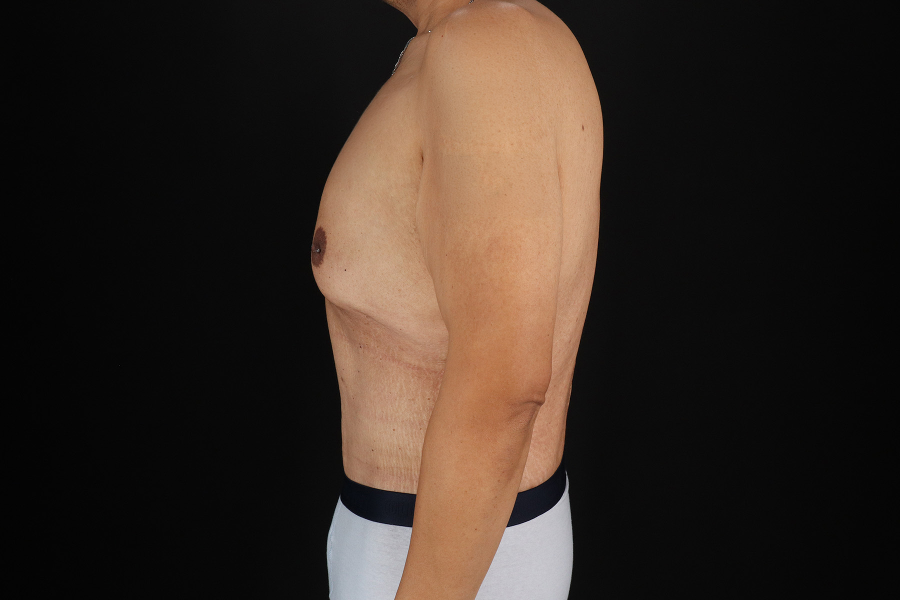 Circumferential Body Lift Before & After Patient #4497