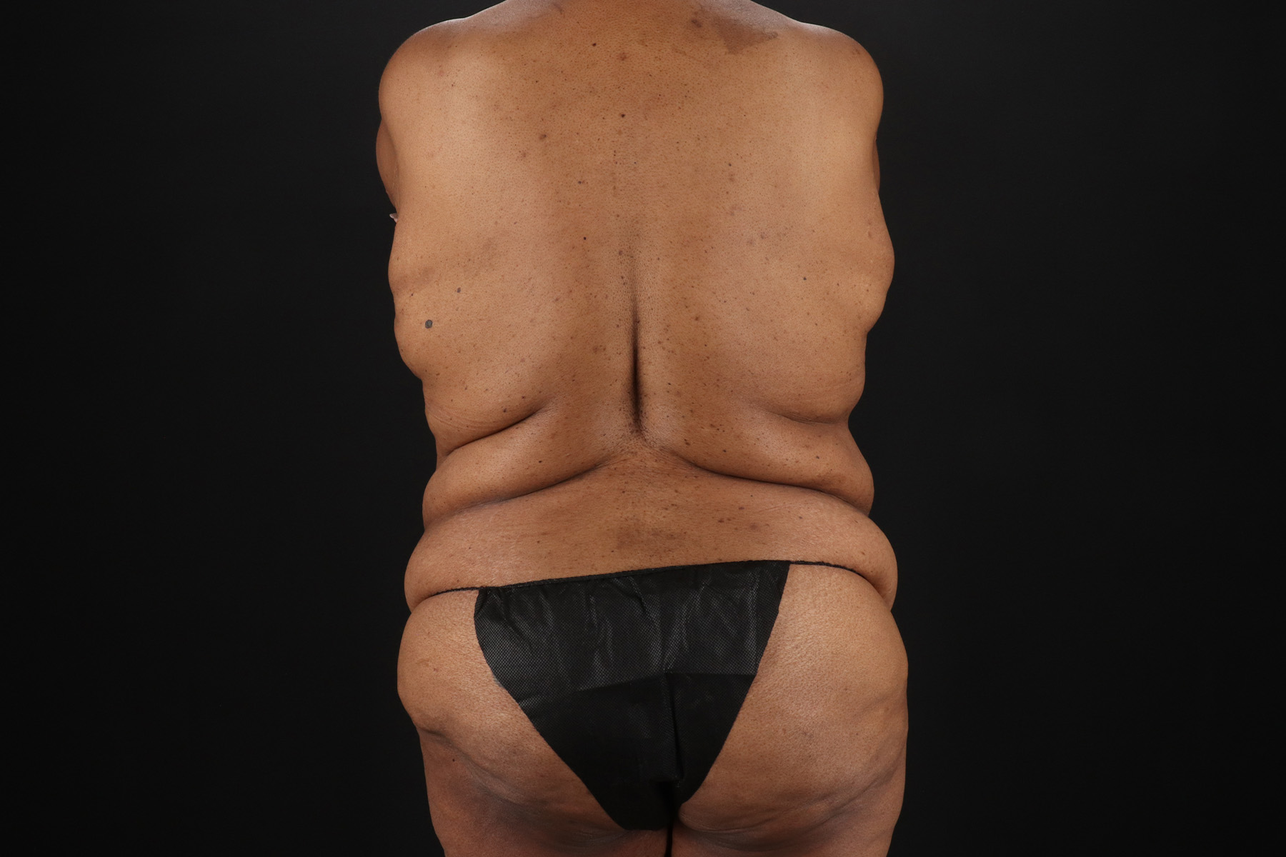 Circumferential Body Lift Before & After Patient #4494