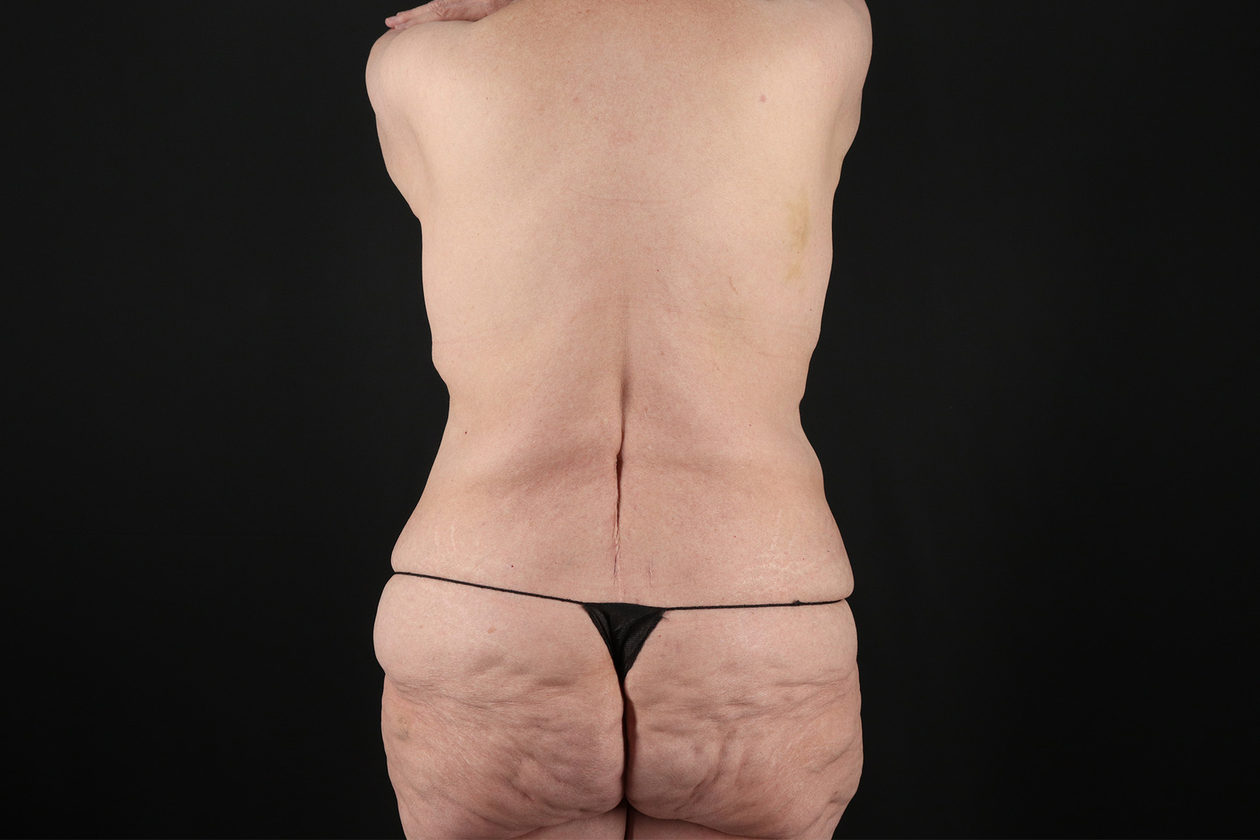 Circumferential Body Lift Before & After Patient #4504