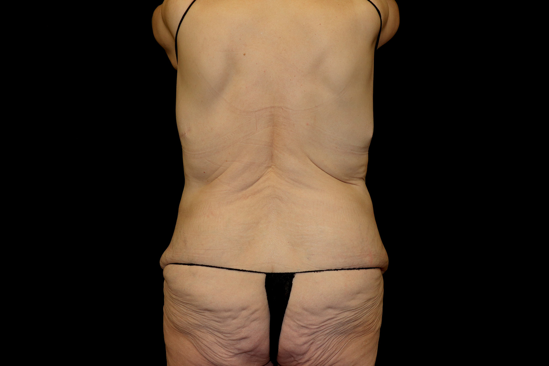 Circumferential Body Lift Before & After Patient #4495