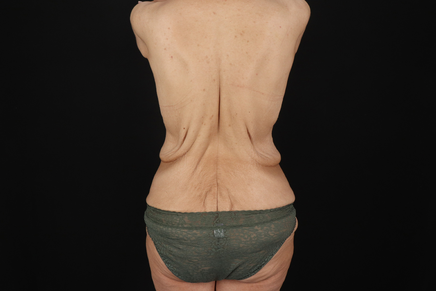 Circumferential Body Lift Before & After Patient #4489