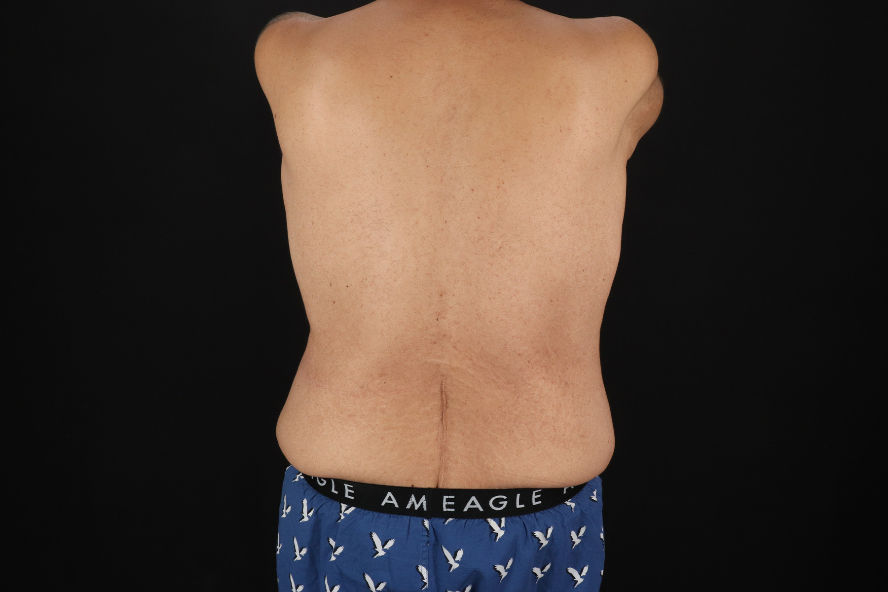 Circumferential Body Lift Before & After Patient #4497