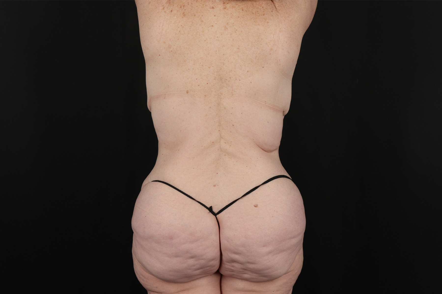 Circumferential Body Lift Before & After Patient #4490