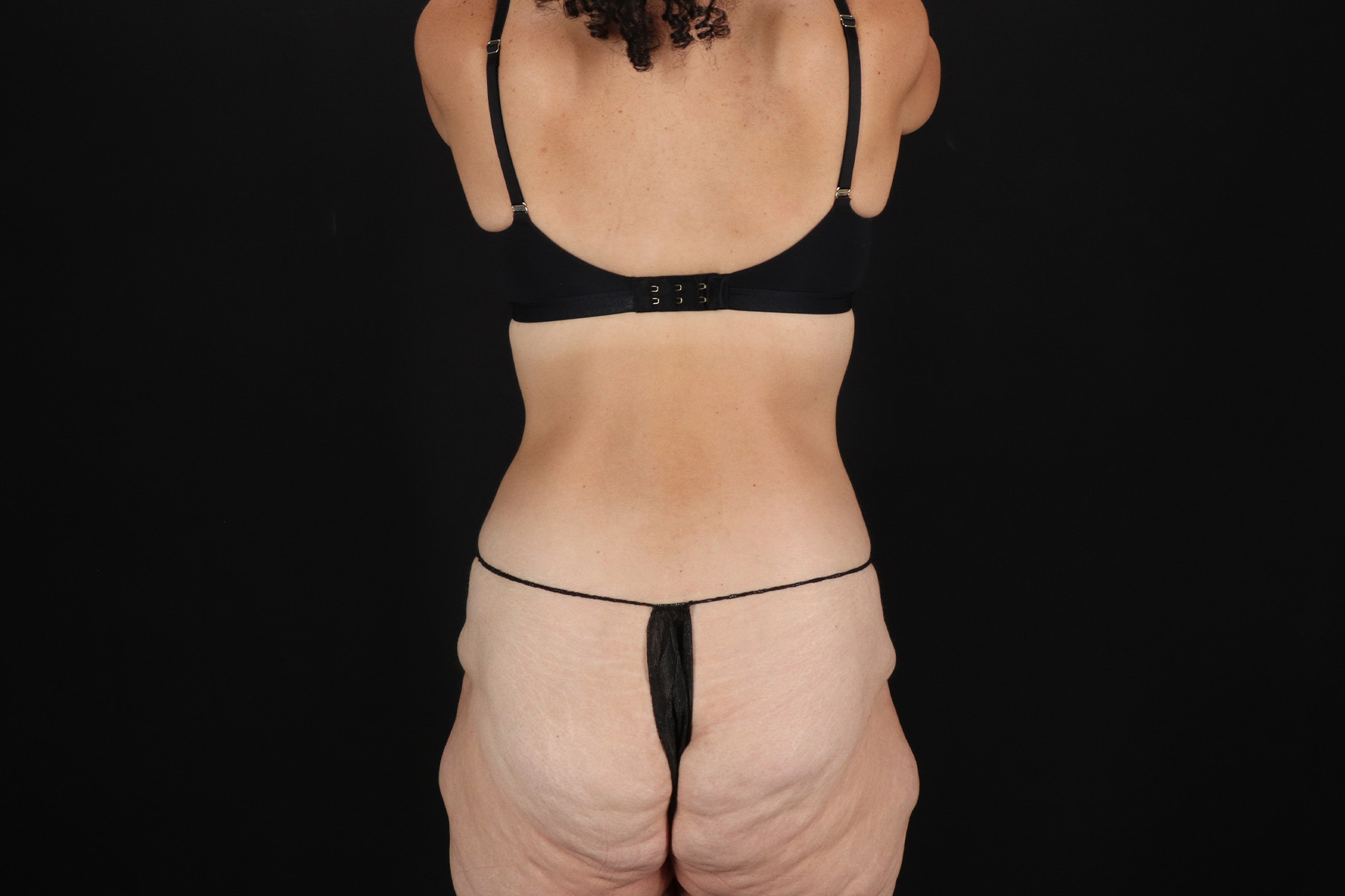 Circumferential Body Lift Before & After Patient #4493