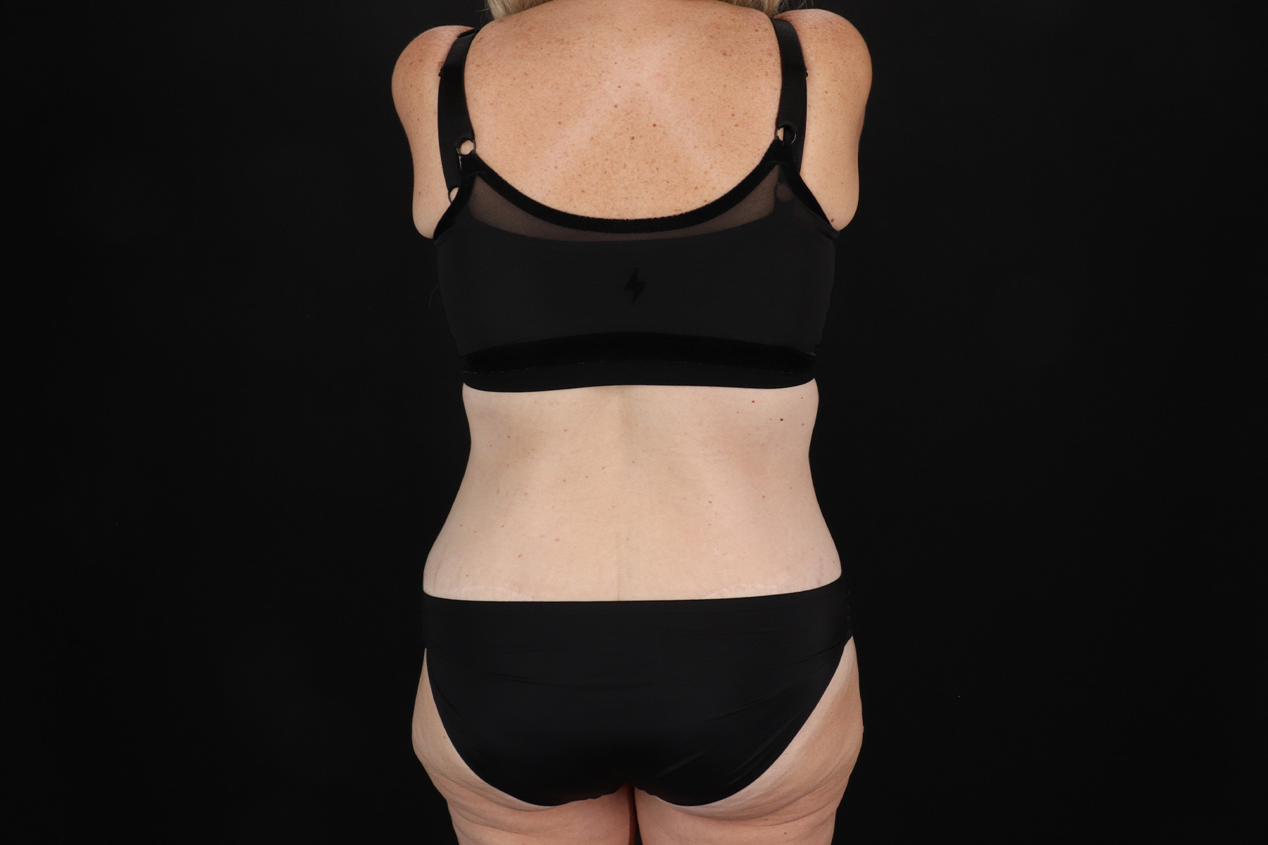 Circumferential Body Lift Before & After Patient #4500
