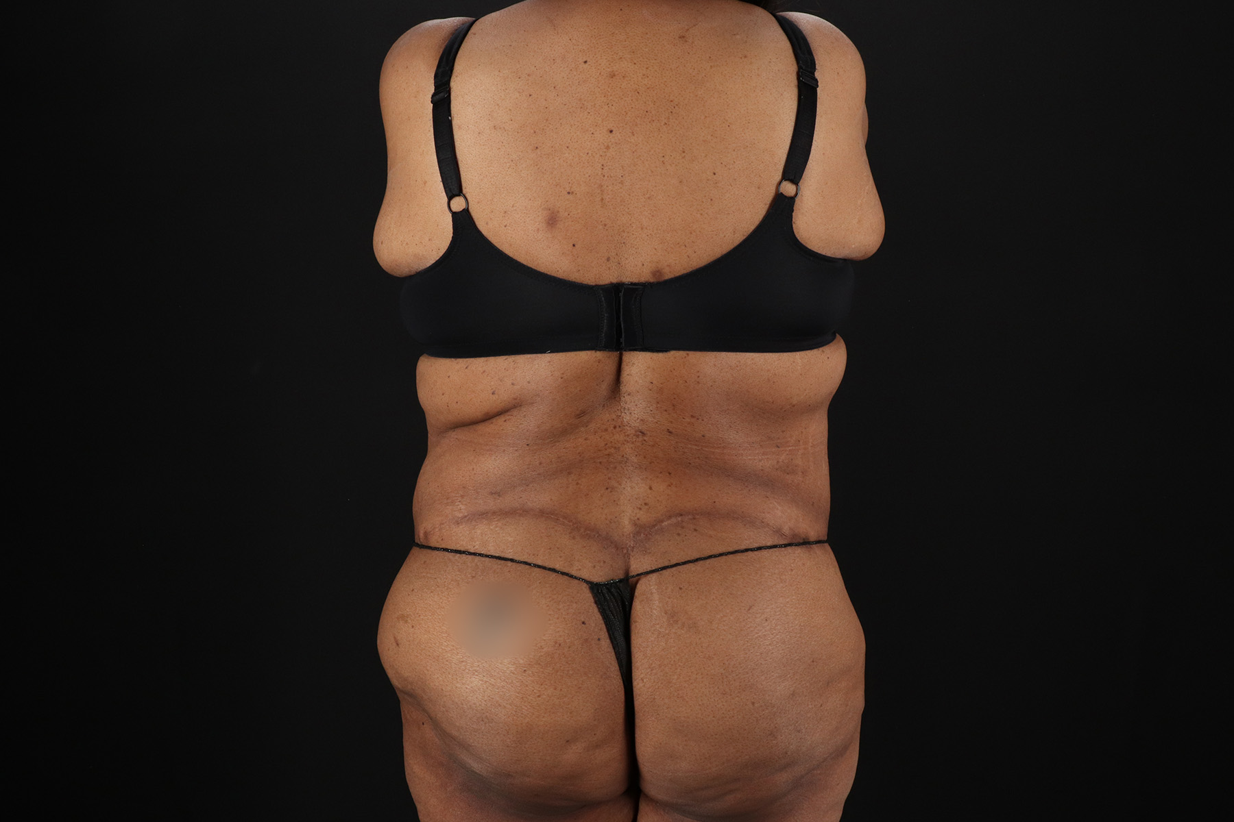 Circumferential Body Lift Before & After Patient #4494