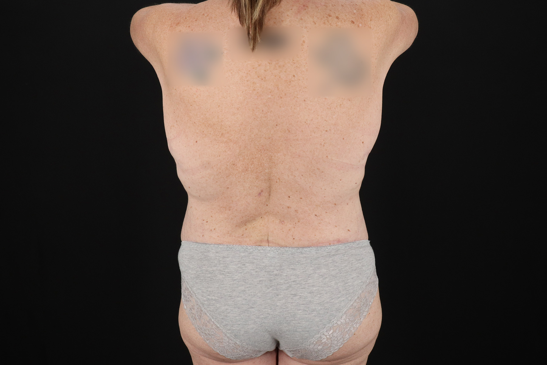 Circumferential Body Lift Before & After Patient #4496