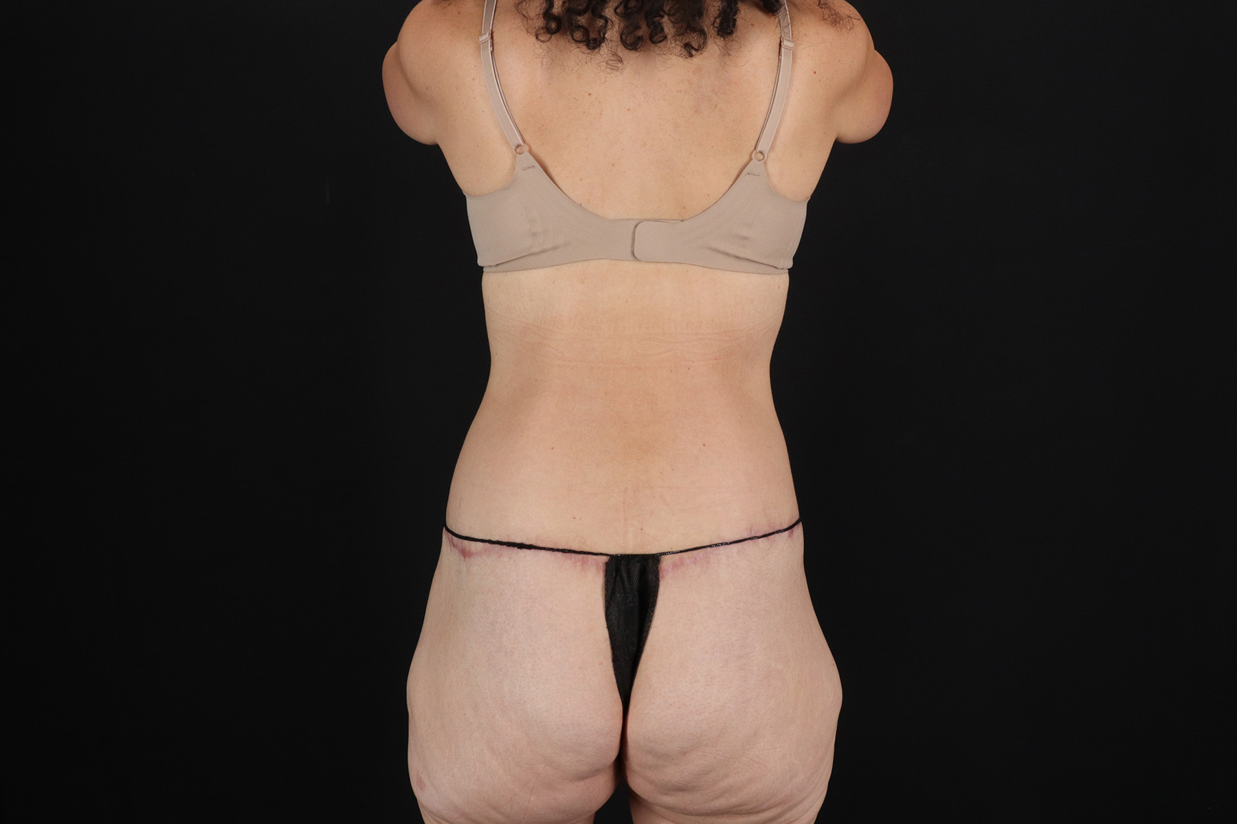 Circumferential Body Lift Before & After Patient #4493