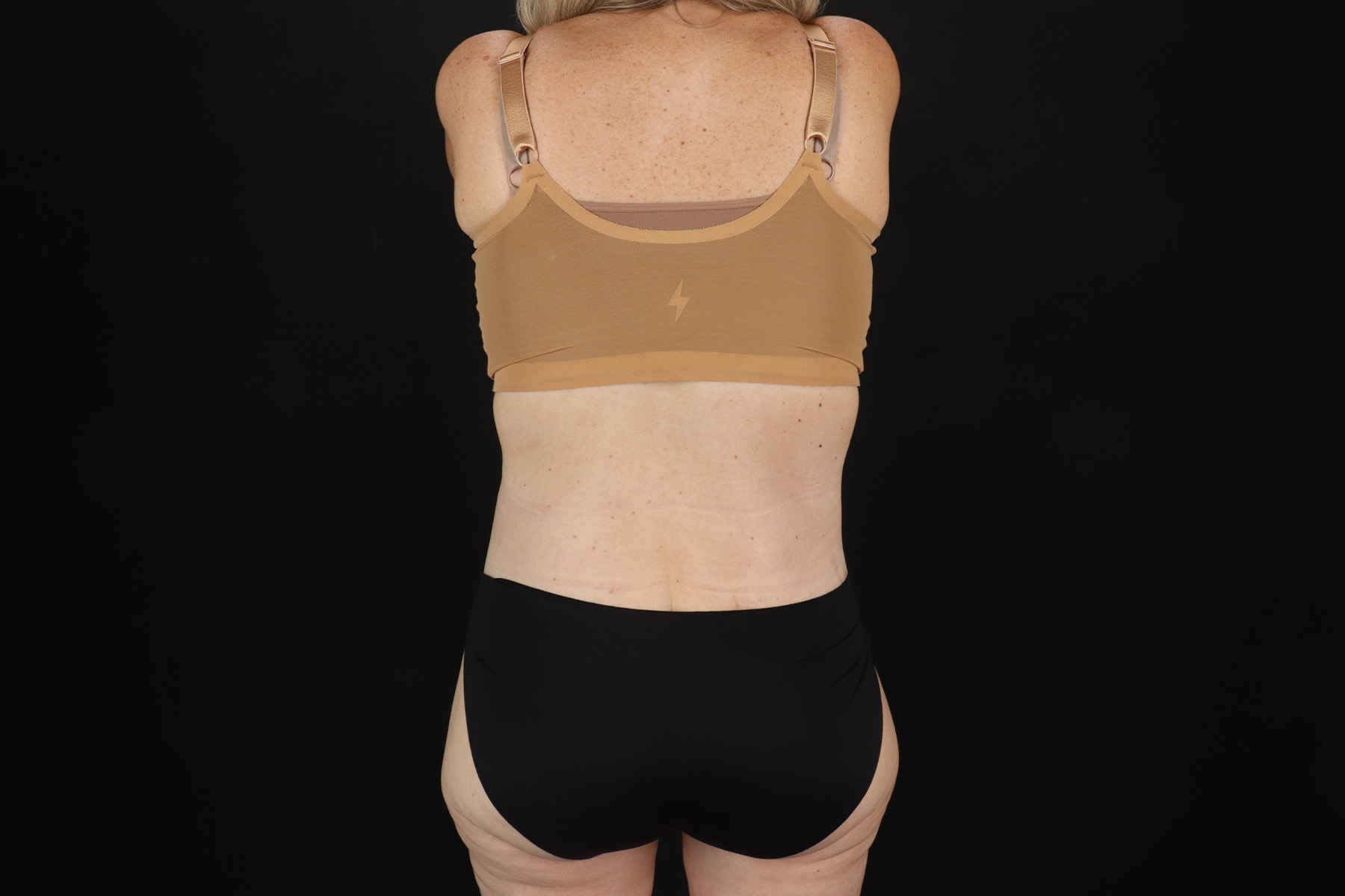 Circumferential Body Lift Before & After Patient #4500