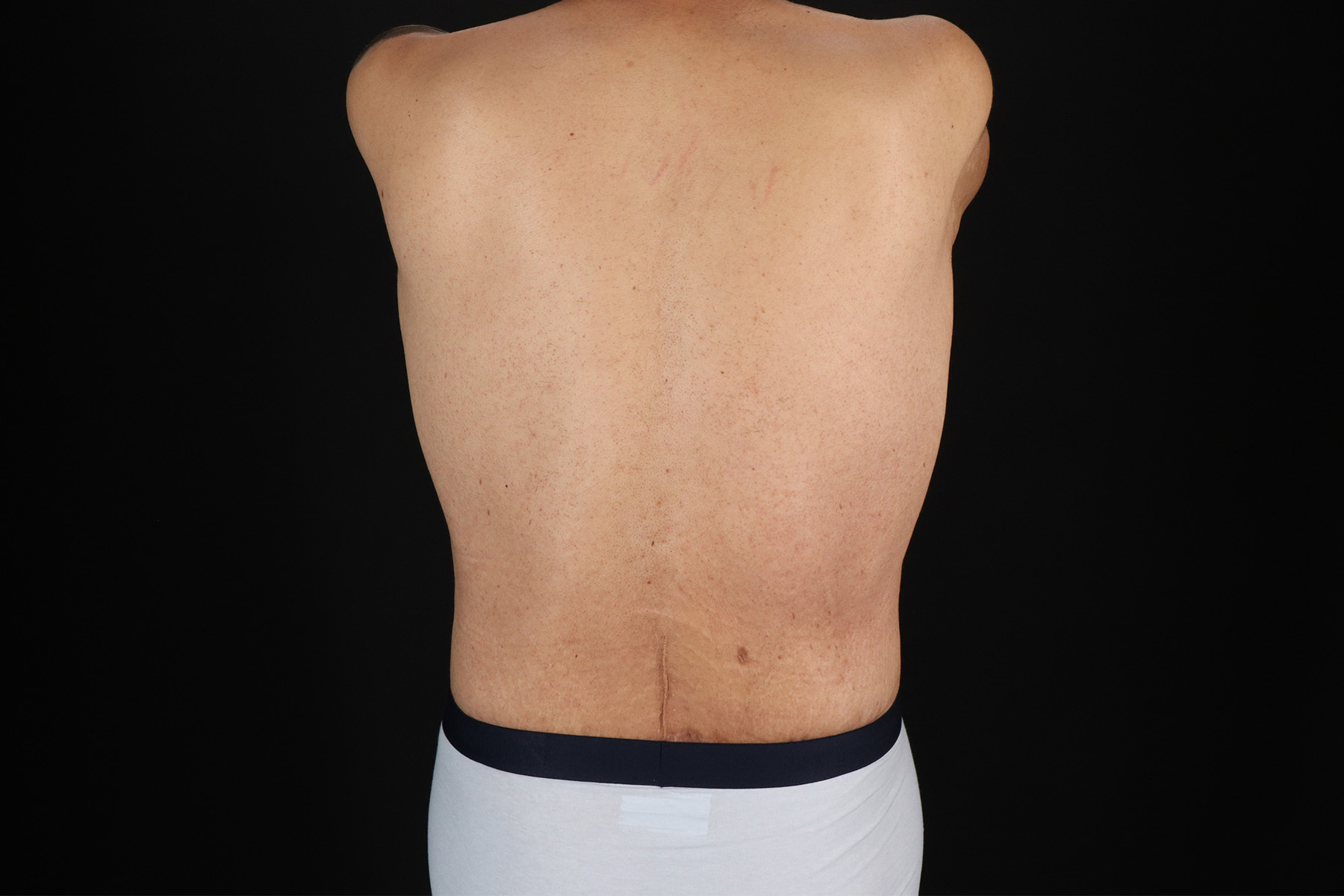 Circumferential Body Lift Before & After Patient #4497