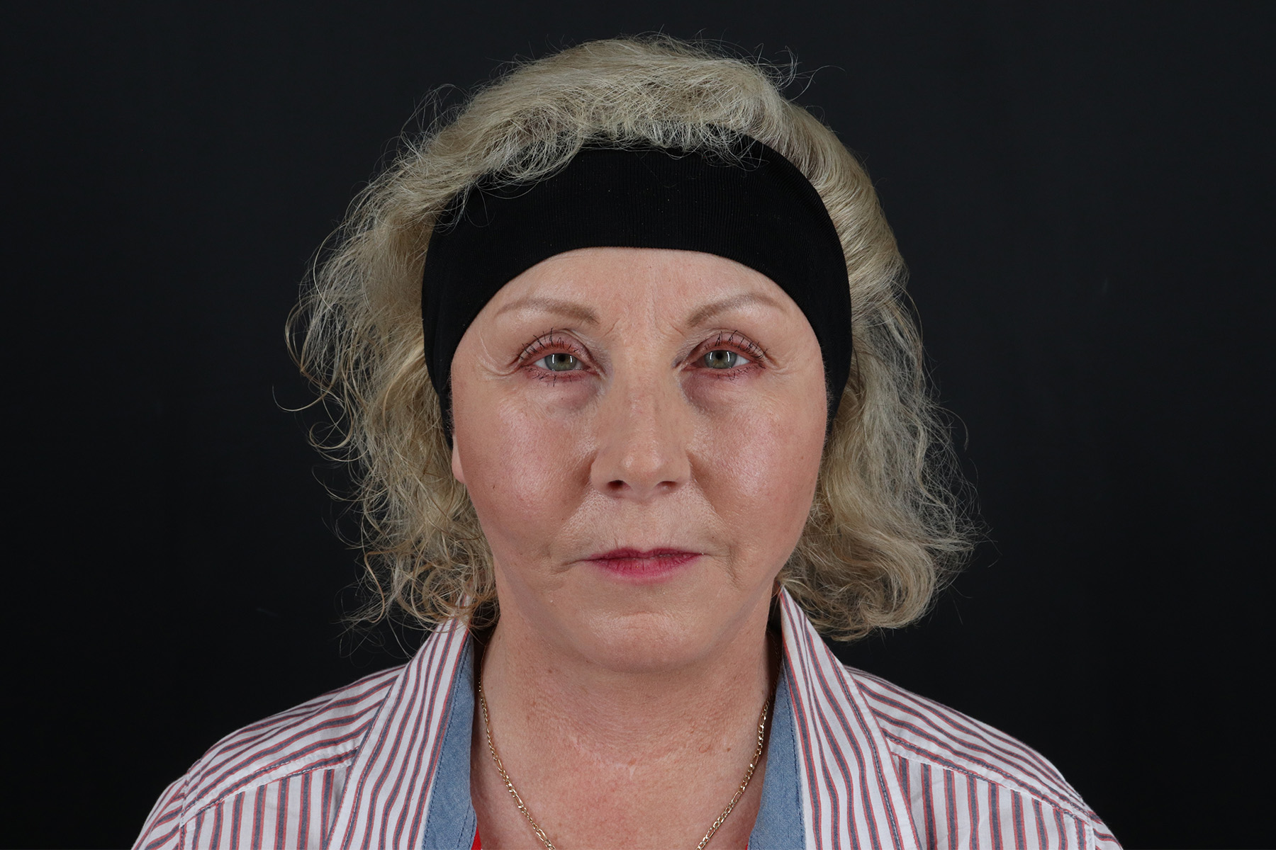 Face & Neck Lift Before & After Patient #4693