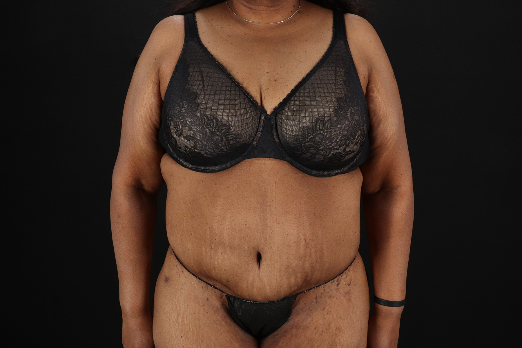 Circumferential Body Lift Before & After Patient #4494