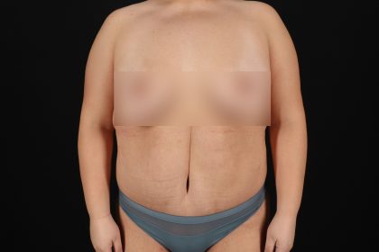 Circumferential Body Lift Before & After Patient #4499
