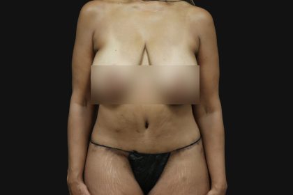 Circumferential Body Lift Before & After Patient #4491
