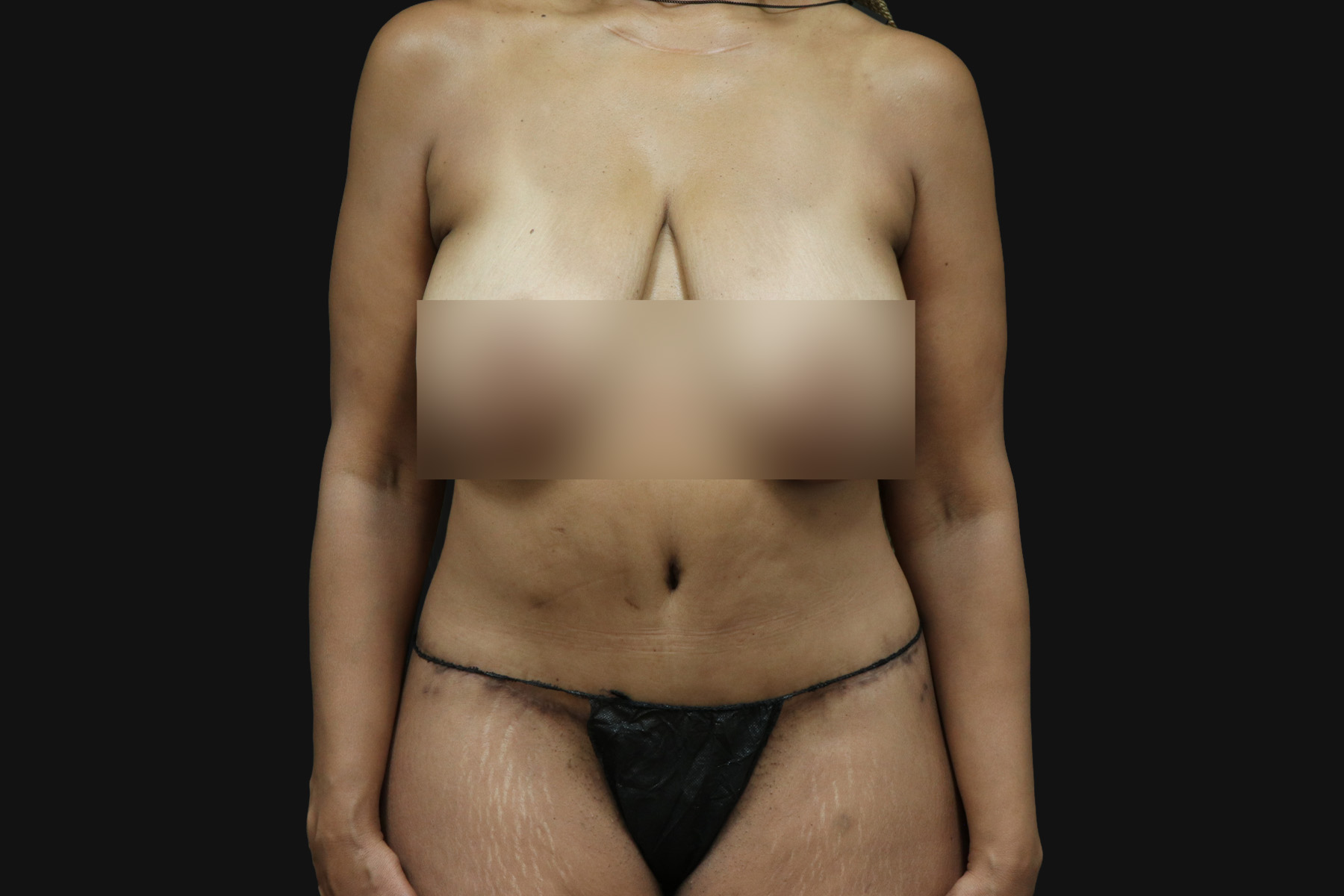 Circumferential Body Lift Before & After Patient #4491