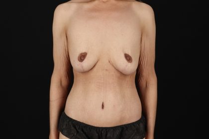 Circumferential Body Lift Before & After Patient #4489