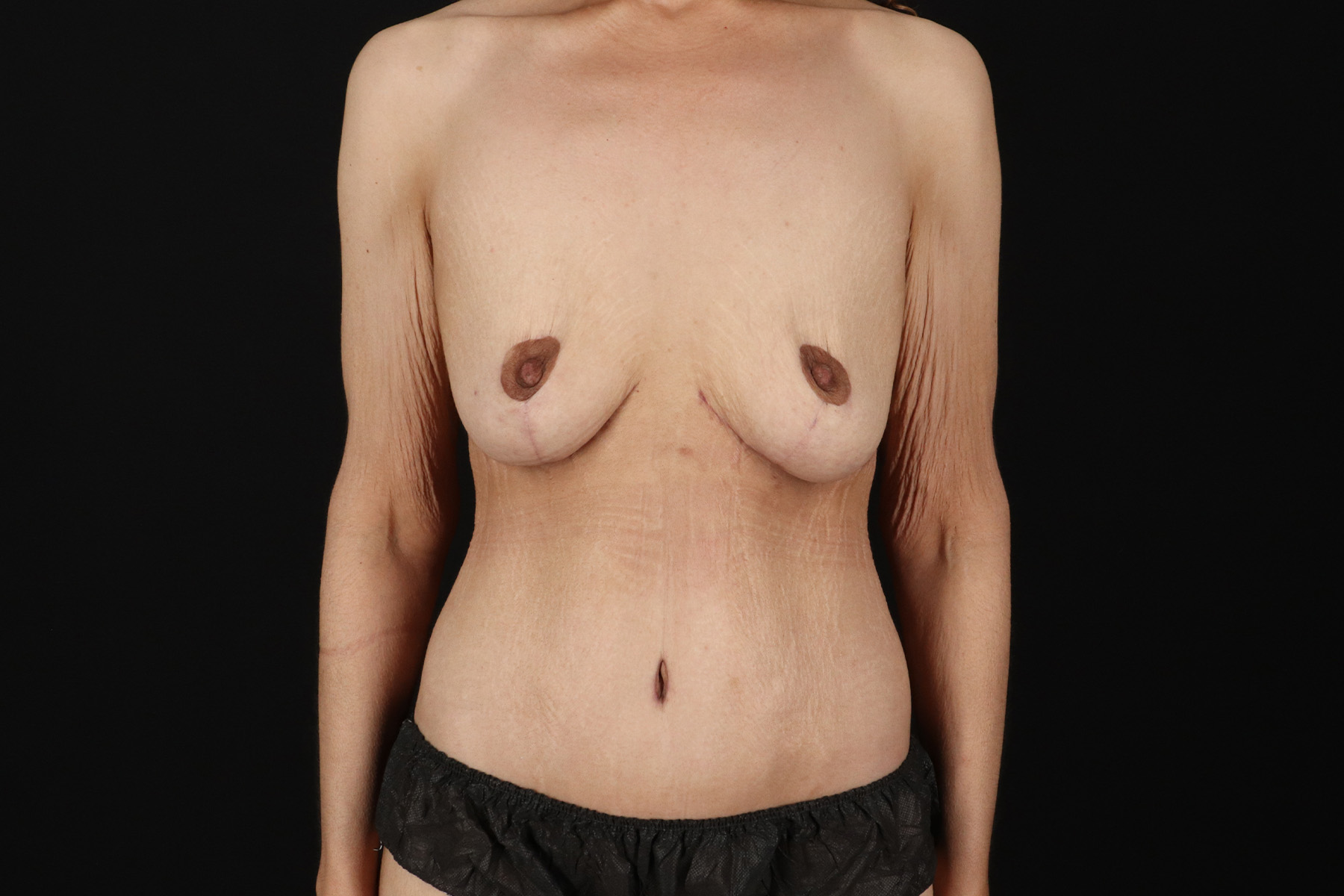 Circumferential Body Lift Before & After Patient #4489