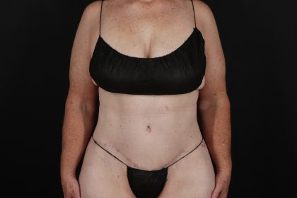 Circumferential Body Lift Before & After Patient #4490